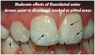 What is dental fluorosis